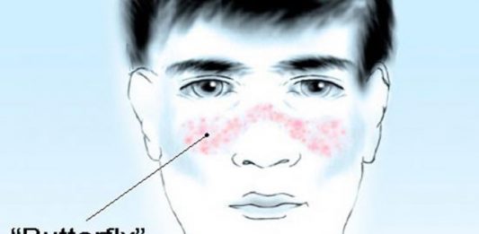 โรคลูปัส (SLE) สาเหตุจากระบบภูมิคุ้มกันเสีย โรคลูปัส